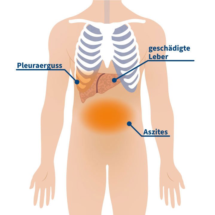 Grafische Darstellung einer geschädigten Leber mit Pleuraerguss und Aszites